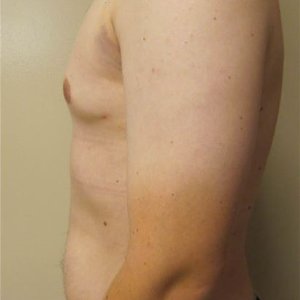 manhattan gynecomastia surgery after 6